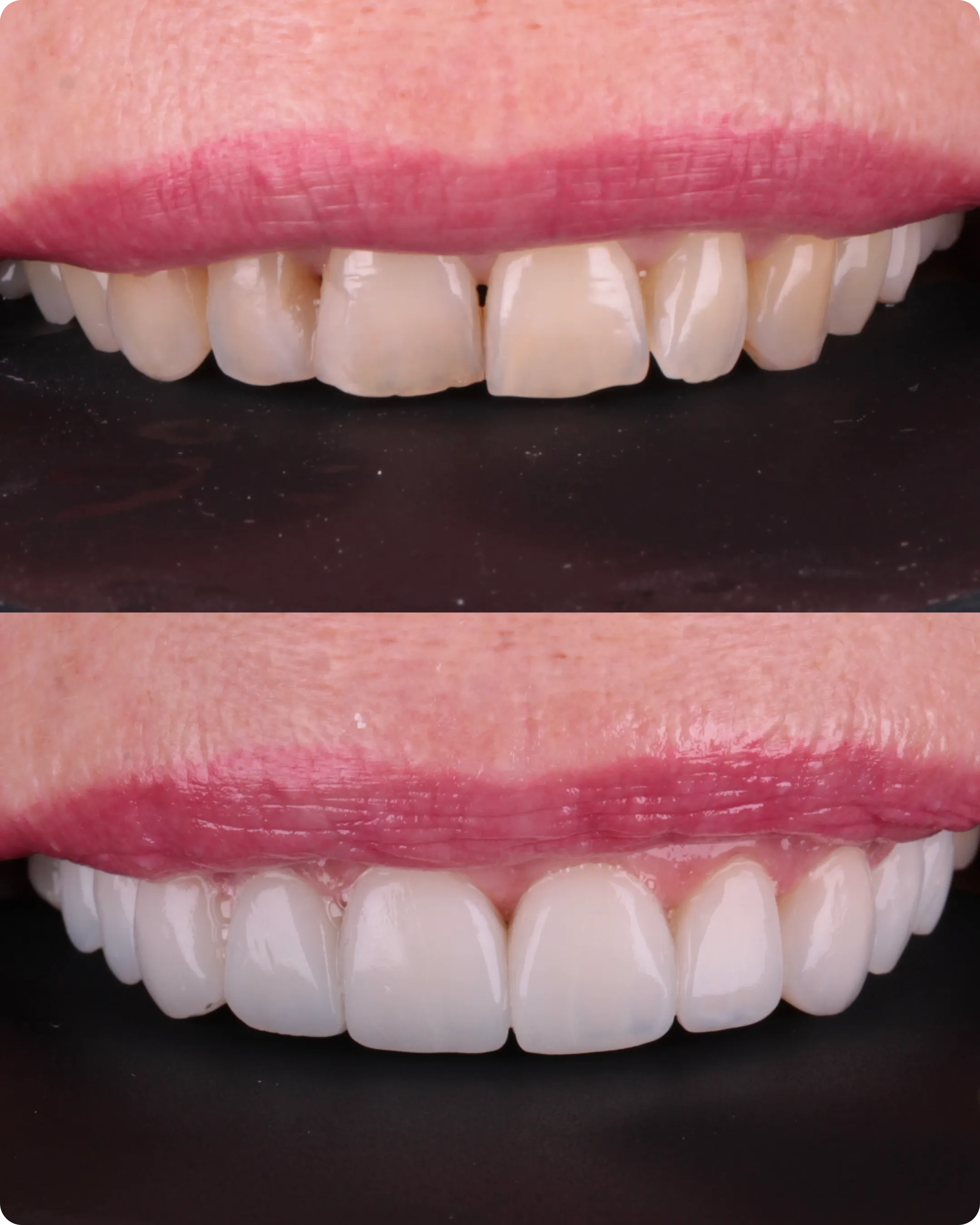 Comparação frontal do sorriso em dois momentos, mostrando diferenças no formato e na cor dos dentes