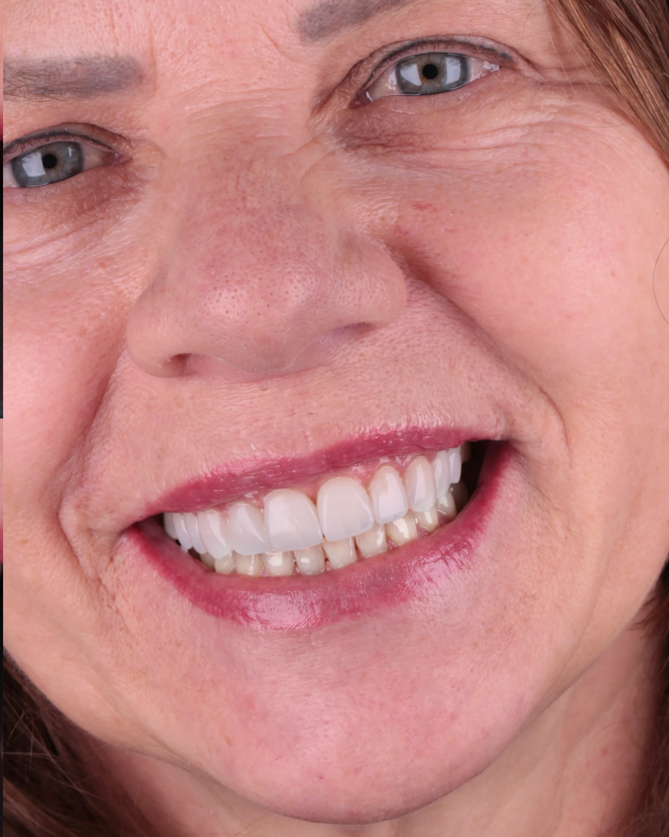 Mulher sorrindo em close, com os dentes superiores e inferiores à mostra
