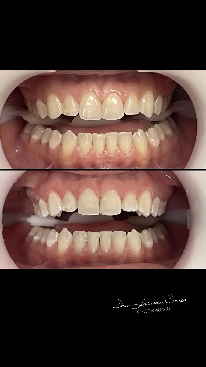Comparação da tonalidade dos dentes em dois registros de clareamento dental em consultório