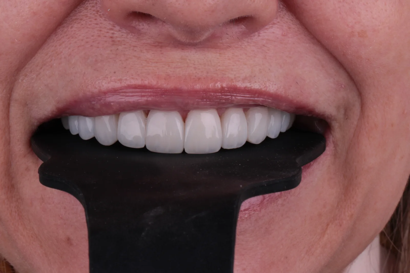 Detalhe frontal dos dentes superiores com um instrumento de contraste durante registro odontológico