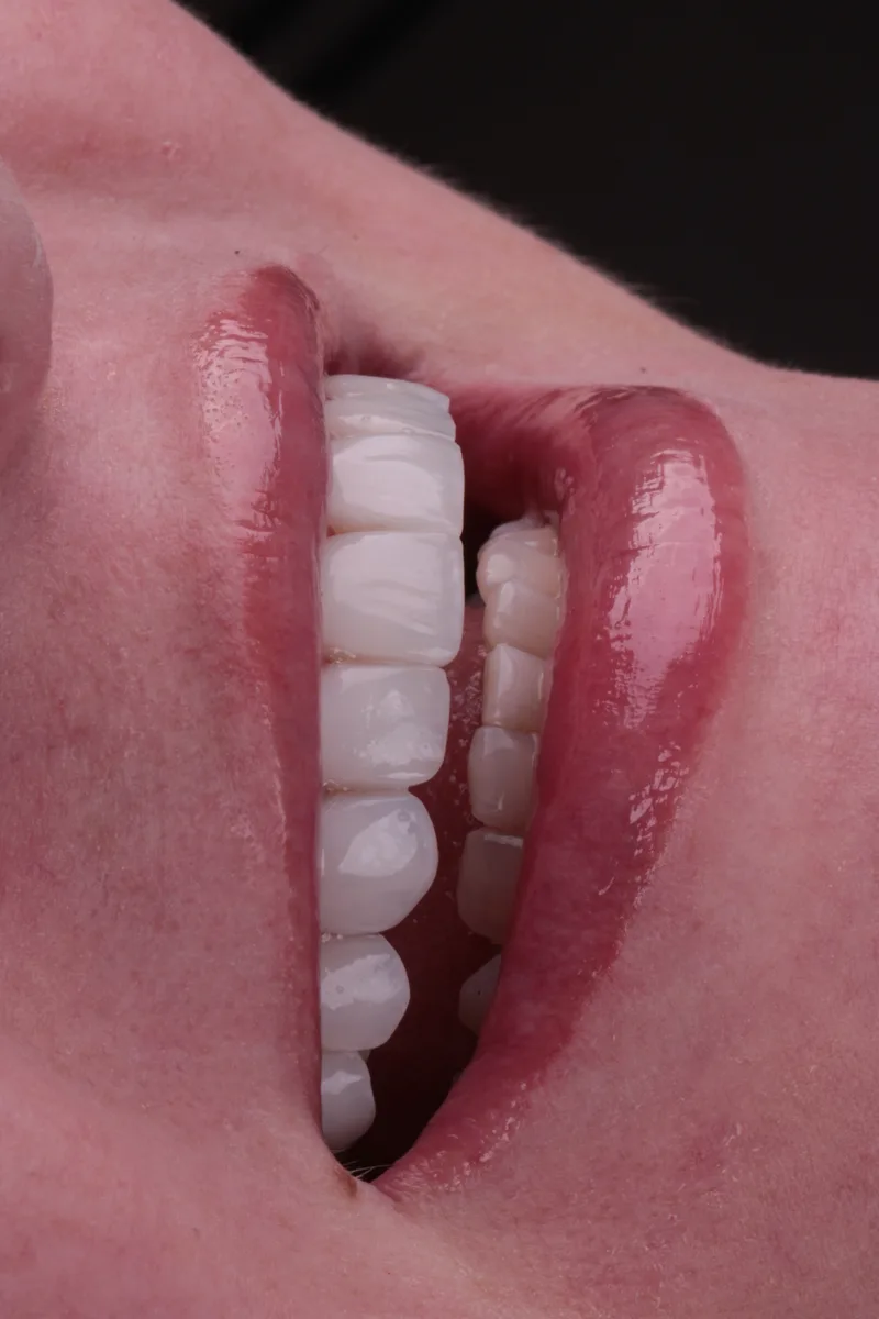 Fotografia aproximada do sorriso em vista lateral, com os dentes e os lábios em destaque