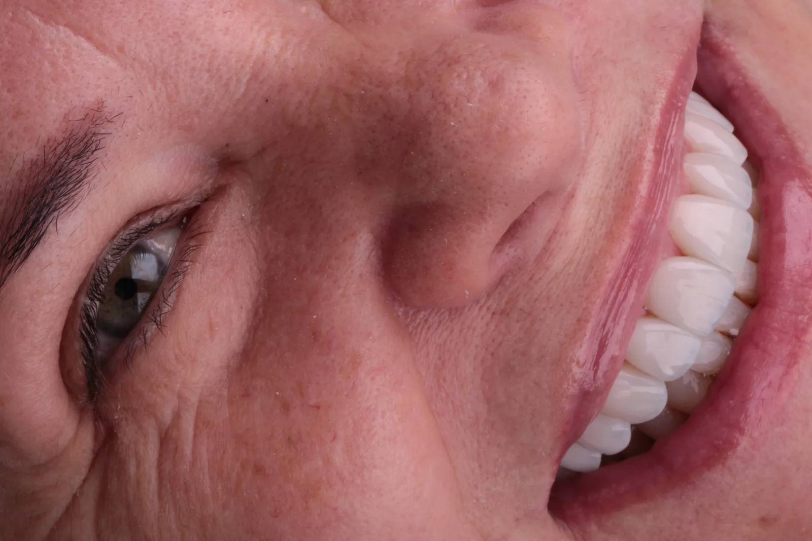 Close do rosto de uma mulher sorrindo, mostrando os dentes superiores