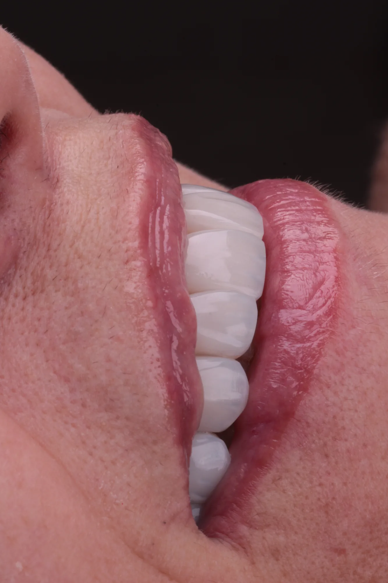 Vista lateral de um sorriso, mostrando o contorno e o alinhamento dos dentes anteriores